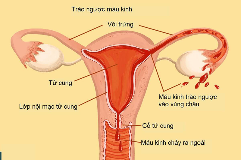 Lạc nội mạc tử cung gây vô sinh cho khoảng 50% phụ nữ mắc bệnh