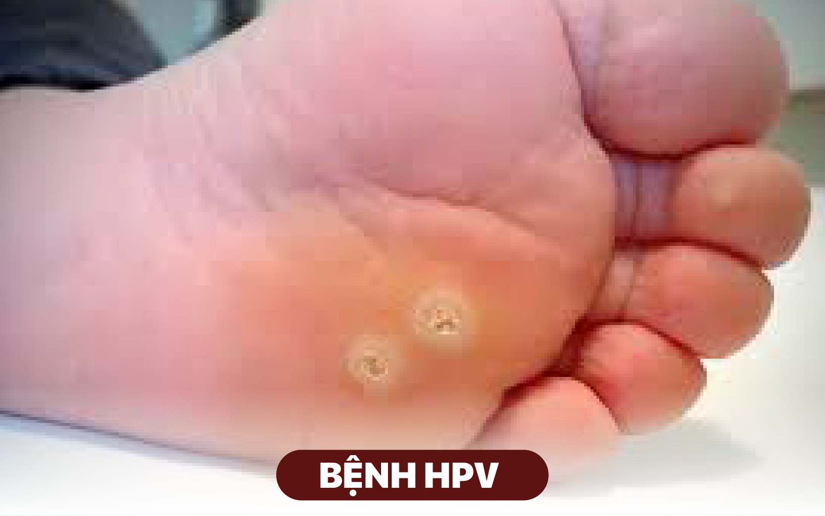 Bệnh HPV gây ra những u nhú trên da ở vùng sinh dục